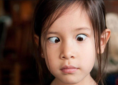 Trẻ hiếng mắt có phải chữa trị?
