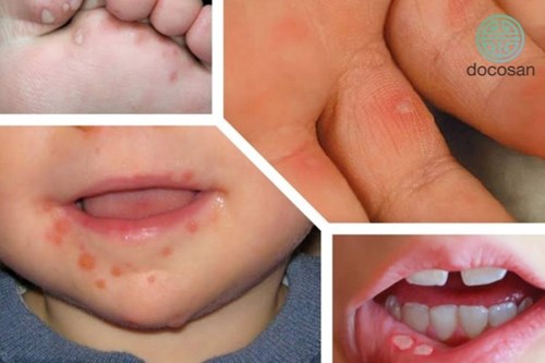 Các dấu hiệu nhận biết bệnh tay chân miệng, các dấu hiệu nặng và hướng dẫn chăm sóc, phòng lây nhiễm bệnh tại nhà