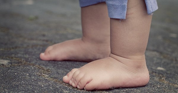 Tìm hiểu hội chứng bàn chân bẹt