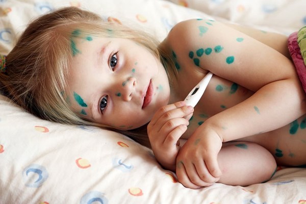 Bệnh thủy đậu ở trẻ em: dấu hiệu, nguyên nhân và cách phòng ngừa