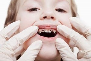 Sâu răng trẻ em: Tác hại, cách điều trị và phòng ngừa hiệu quả