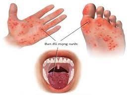 Bệnh tay chân miệng: Nguyên nhân dấu hiệu nhận biết và cách điều trị