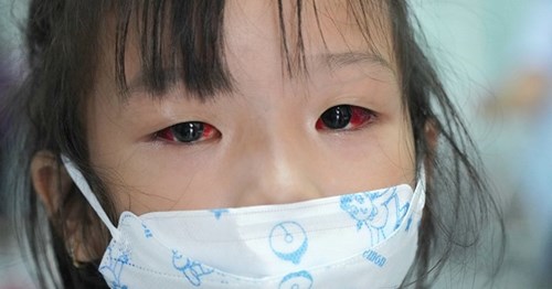 Bệnh đau mắt đỏ: Triệu chứng, nguyên nhân và lưu ý cần biết