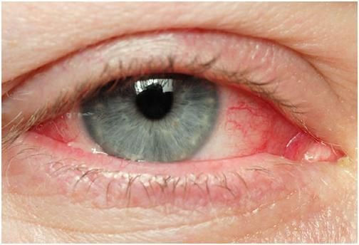 Cách điều trị đau mắt đỏ