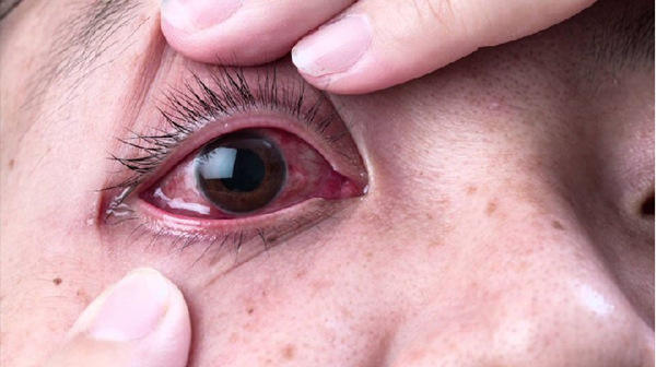 Không tự ý điều trị bệnh đau mắt đỏ tại nhà