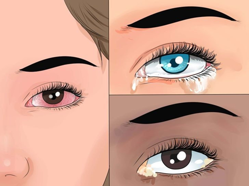 Phòng tránh bệnh đau mắt đỏ