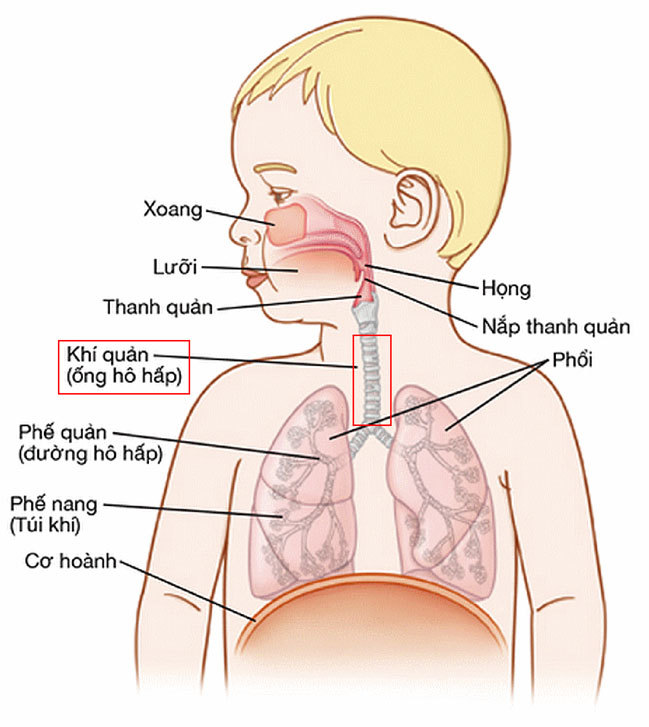 Thở khò khè - dấu hiệu hẹp khí quản nguy hiểm ở trẻ
