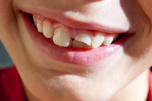 Cần làm gì khi trẻ bị ngã chấn thương răng?