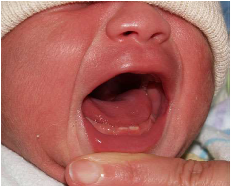 Giúp trẻ không sốt khi mọc răng- lớp nhà trẻ D1