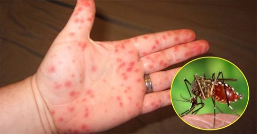 4 vấn đề sức khỏe bạn có thể gặp sau khi khỏi sốt xuất huyết