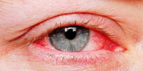 Dấu hiệu nhận biết đau mắt đỏ !