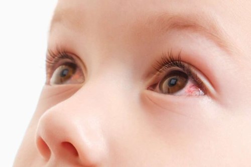 Nguyên nhân, triệu chứng, điều trị và dinh dưỡng của bệnh đau mắt đỏ