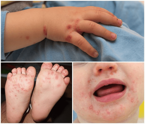 Triệu chứng và cách chăm sóc bệnh tay chân miệng ở trẻ em