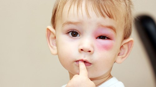 Dấu hiệu nhận biết và cách phòng tránh bệnh Đau mắt đỏ
