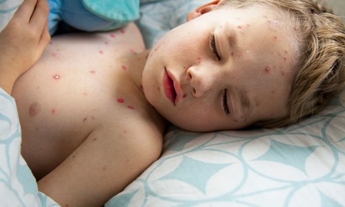 Bệnh Thủy Đậu ở trẻ em: Dấu hiệu, nguyên nhân và cách phòng ngừa