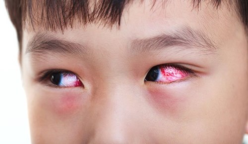Bị đau mắt đỏ bao lâu sẽ khỏi hẳn?
