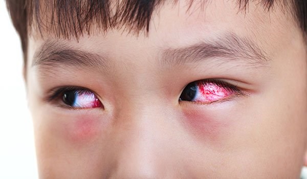 Bị đau mắt đỏ bao lâu sẽ khỏi hẳn?