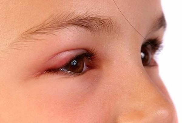 Bệnh viêm kết mạc cấp (đau mắt đỏ) – Những điều cha mẹ cần biết
