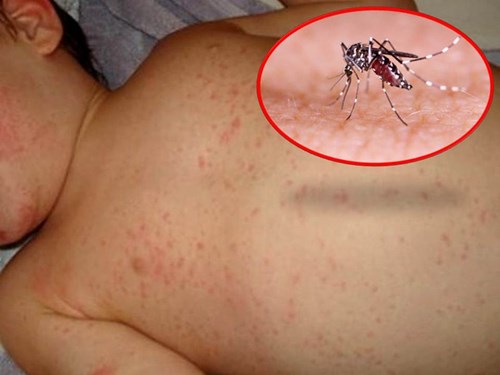 Biểu hiện  bệnh sốt xuất huyết ở trẻ em