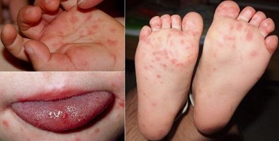 Bệnh tay chân miệng ở trẻ em: Triệu chứng và cách chăm sóc