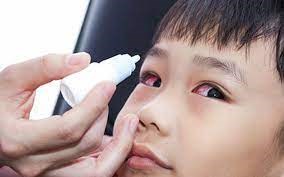 Dịch đau mắt đỏ vào mùa, bé có 5 dấu hiệu sau cha mẹ cần cho con đi khám ngay