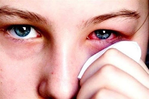Bài tuyên truyền phòng bệnh đau mắt đỏ