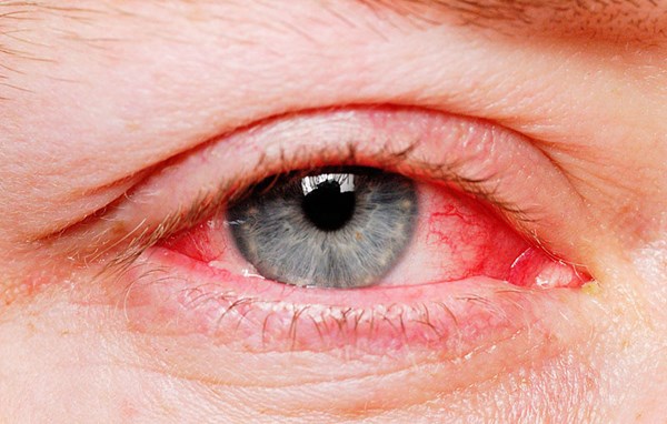 Tuyên truyền về bệnh viêm mắt
