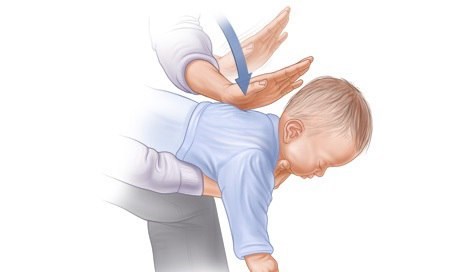 Hướng dẫn sơ cứu xử lý đúng cách khi trẻ bị hóc dị vật đường thở các bậc cha mẹ cần phải biết