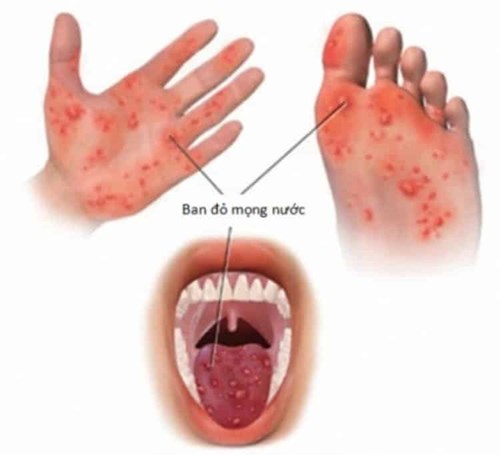 Nhận biết dấu hiệu bệnh tay chân miệng ở trẻ 