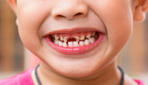 Nguyên nhân, điều trị và cách phòng ngừa sâu răng ở trẻ nhỏ