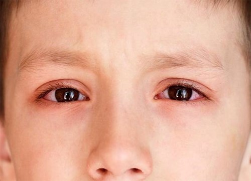 Bệnh đau mắt đỏ ở trẻ em và những điều cha mẹ cần biết