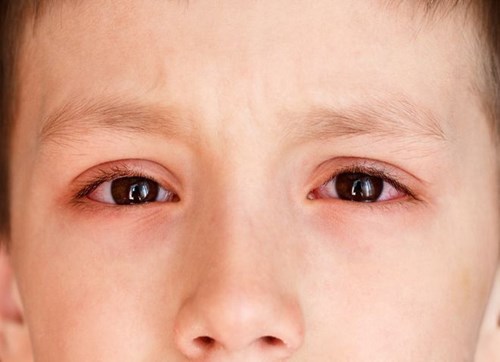 Triệu chứng bệnh đau mắt đỏ ở trẻ em
