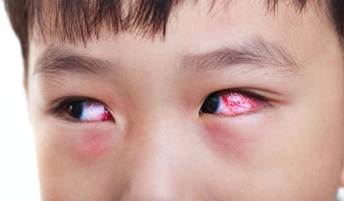 Cách phòng bệnh đau mắt đỏ ở trẻ em