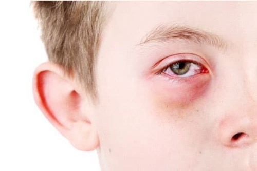 Nguyên nhân của đau mắt đỏ ở trẻ