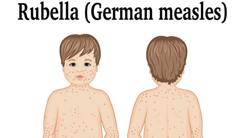 Bệnh rubella 