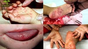 


bài tuyên truyền dịch bệnh tay - chân - miệng, hướng dẫn vệ sinh khử khuẩn chủ động phòng chống bệnh tay - chân -miệng
năm học:  2018 - 2019
