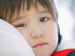 Mùa mưa bão, chủ động phòng bệnh đau mắt đỏ cho trẻ