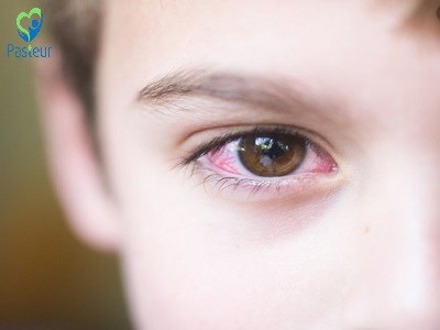 Cách phòng bệnh đau mắt đỏ ở trẻ em