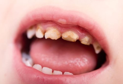Sâu răng ở trẻ em: Nhận biết, nguyên nhân và điều trị