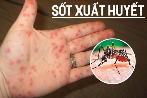 Khi nào nên thực hiện test nhanh phát hiện sớm sốt xuất huyết?