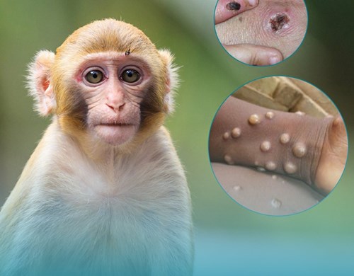 Hướng dẫn-chẩn đoán-điều trị-phòng tránh bệnh đậu mùa khỉ.